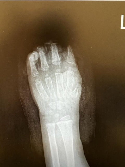 Rozrywane dłonie, poparzenia i oślepienia. Pirotechnika to nie tylko sylwestrowy temat